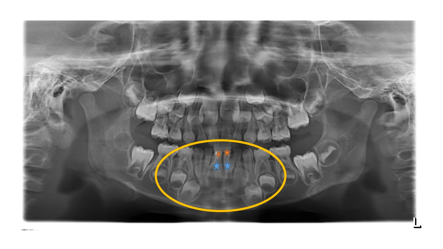 成長期の矯正について 歯の豆知識 四街道市 あさひクリニック歯科 矯正歯科