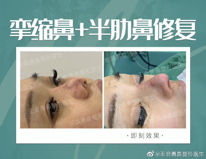 王会勇和刘波哪个鼻修复厉害 刘波王会勇隆鼻对比谁好 整容资讯网