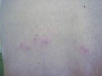 ダニに刺されたときの症状 ダニを退治するブログ