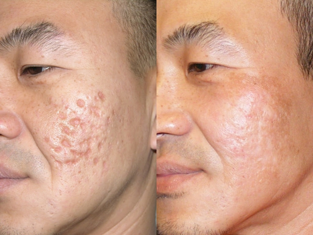 Is Dermapen Good For Acne