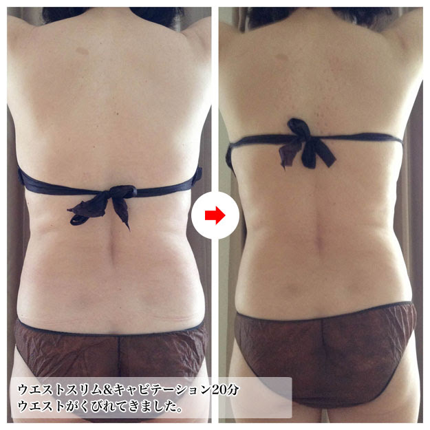 背中のラインがくびれて綺麗になってきました プロスパービューティー