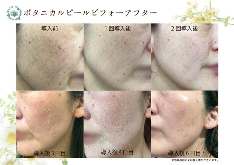 春日井 ボタニカルピール 60分 美容室 Frangipani