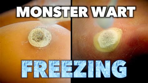 They are hard and grainy and can also grow inward. 2 MONSTER WARTS vs 1 MOTHER & SON (Frozen With Liquid