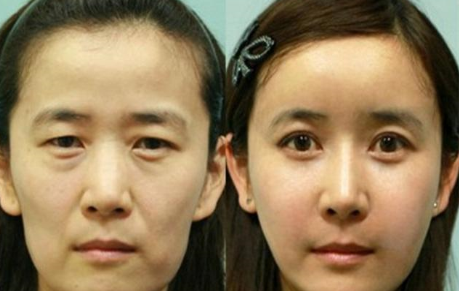 韩国女性整容前后对比图完全就是脱胎换骨 美帮网