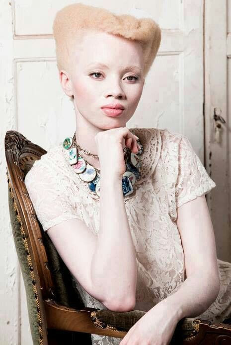 View source image Image result for female nigerian albino