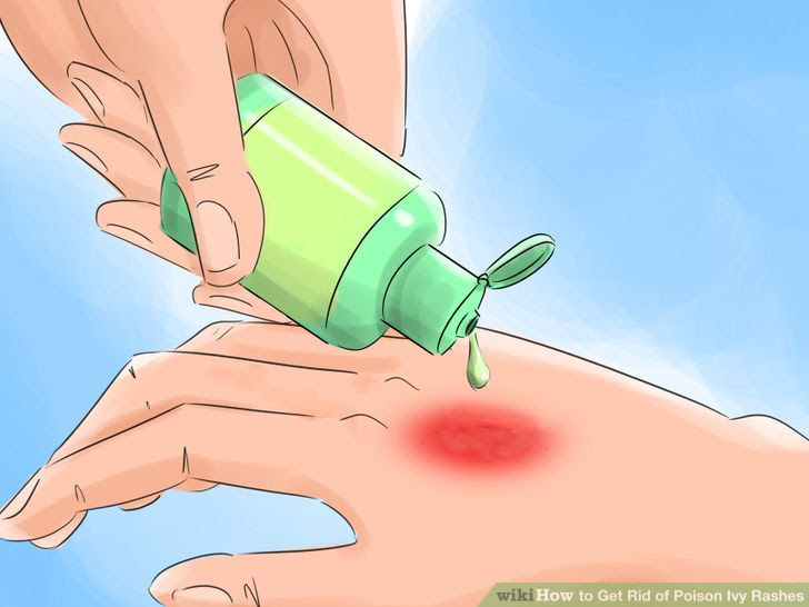 Get Rid of Poison Ivy Rashes Step 18 Version 2.jpg
