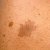 Lump On Shoulder Blade Bone - It exists for informational purposes only.