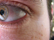 Bloodshot Eye