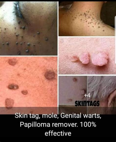 Warts are growths on your skin that are quite contagious and very common, affecting 3 to 5% of adults. How To Get Rid Of Skin Tags, Genital Warts And Mole