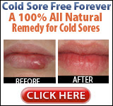 Cold Sores Vs Mouth Ulcers : Fever Blister Viral Infection