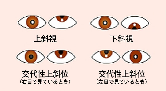 子どもの斜視 福永眼科医院 姫路駅から北へ5分