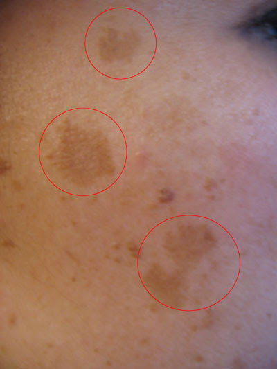 Skin Hypopigmentation and Hyperpigmentation Restore Treatment 