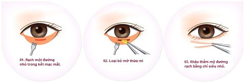 lấy mỡ mí mắt dưới-3