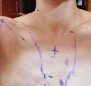 がん バッテン 元気隊 乳がん体験談