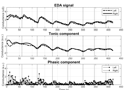 Electrodermal Activity In Relation To Diabetes Autonomic Neuropathy And Aging A Preliminary Study