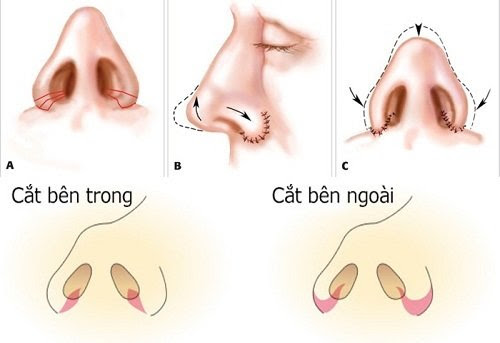 Cắt cánh mũi giải pháp cho cánh mũi to rộng và dày
