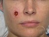 Early Stage Skin Cancer On Upper Lip : cleft lip picture | Medical Pictures Info - Health : Its two main characteristics are uncontrolled growth of the cells in the human body and the ability of these cells to migrate from the original site and spread to distant sites.