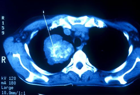 Lung Scan Indicating Cancer