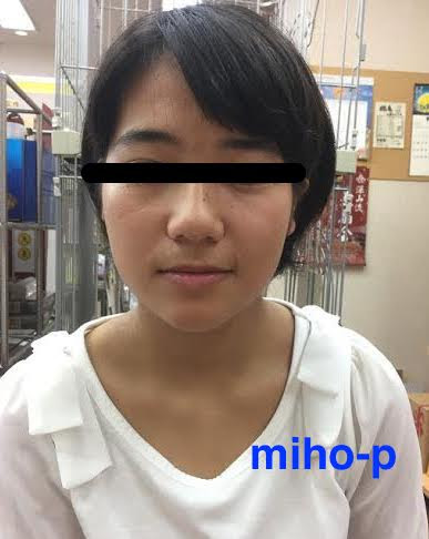 アトピー性皮膚炎の改善例 美保薬局 福島県いわき市の皮膚病お悩み相談専門の経験豊富な薬局です