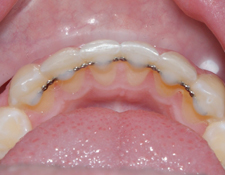 What to do if permanent retainer comes 
