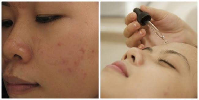Giải mã tất tần tật về phương pháp peel da hoá học trị sẹo mụn thần thánh - Ảnh 5.