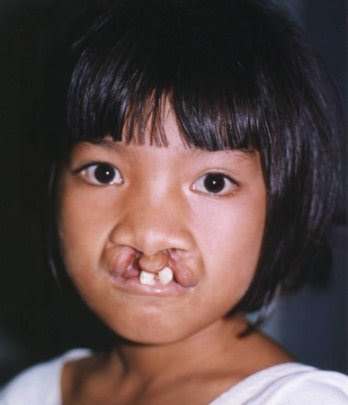  dedicated to helping children and young adults with cleft lip and palate 