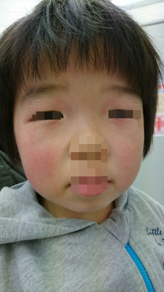 まぶたが腫れる 野田市 小児科 千葉県 こどもの花粉症 こどもの漢方 喘息 アトピー性皮膚炎 アレルギー 結節性痒疹 たんぽぽこどもクリニック