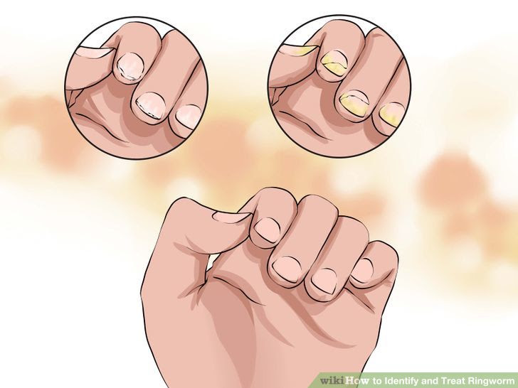 Identify and Treat Ringworm Step 6 Version 2.jpg