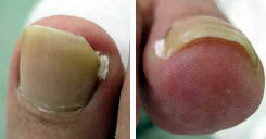 陥入爪 巻き爪の治療について 守口敬仁会病院