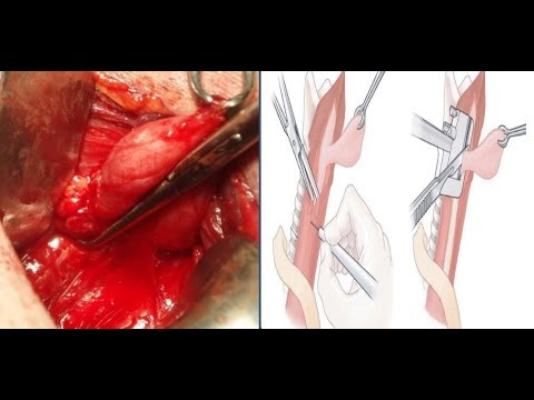 Diverticules sophagiens - Troubles digestifs - Manuels