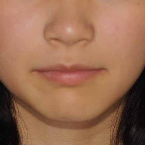 顔のゆがみは 歯並びが原因 矯正後の顔の変化 中学生 東京の矯正歯科なら口コミで人気の 大塚たまみ矯正歯科 へ