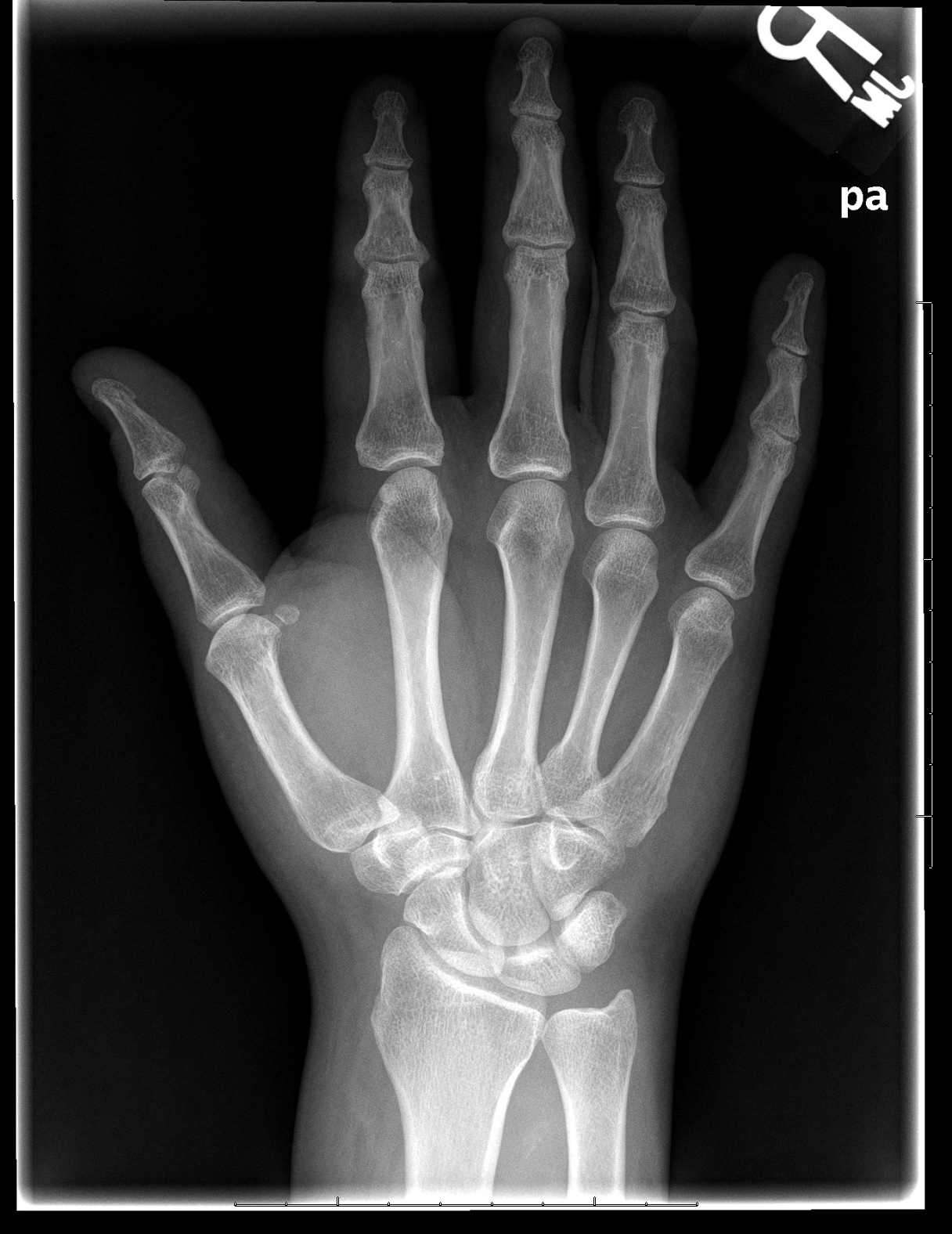 Archive Of Unremarkable Radiological Studies: Right Hand X-Ray - Stepwards