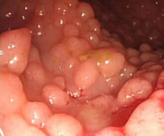 esophageal cancer photos