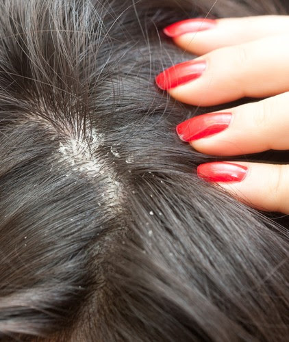Learn how to tell if your flaky scalp is a sign of dandruff or another ...