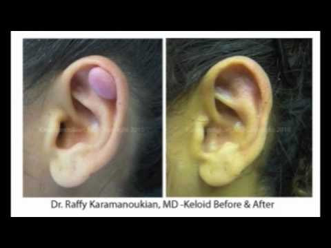 Tags:Los Angeles scar revision keloid scars surgery treatment 