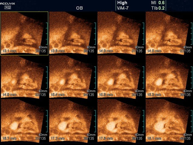 cleft lip before and after. Fetal, cleft lip, MSV.