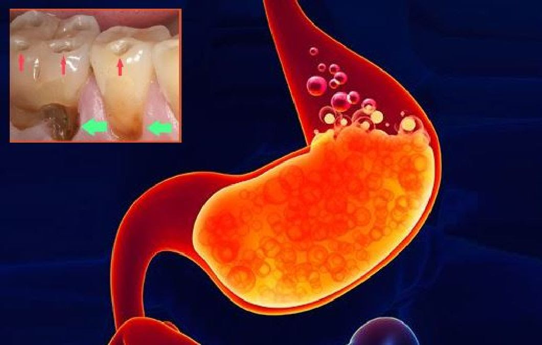 A dentist reveals 5 things to do if you suffer from gastroesophageal acid reflux (GERD)!