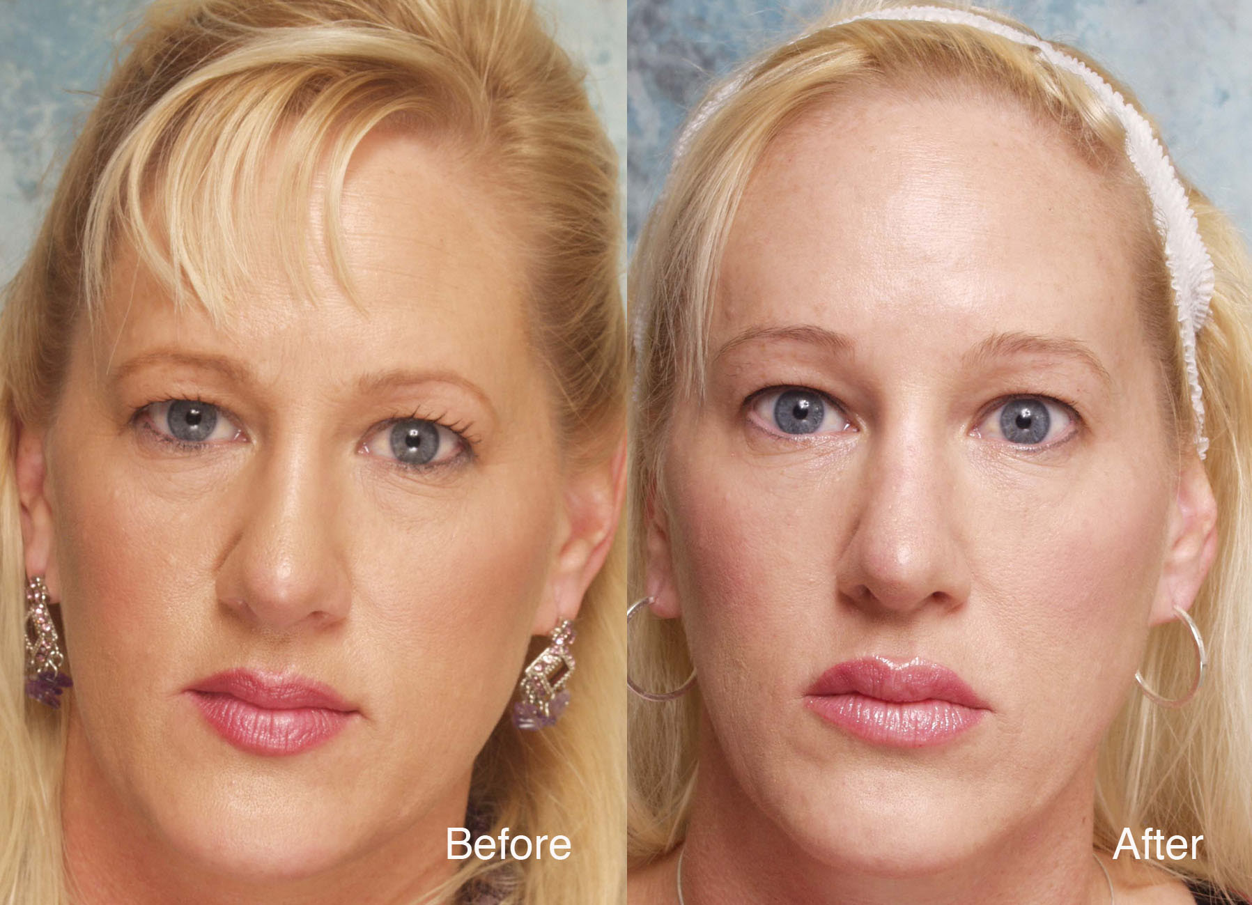 Eyelid Case Study | Beverly Hills Blepharoplasty Cases