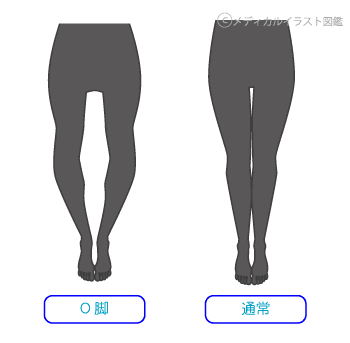 ｏ脚と美脚シルエット メディカルイラスト図鑑 無料の医療 美容素材集