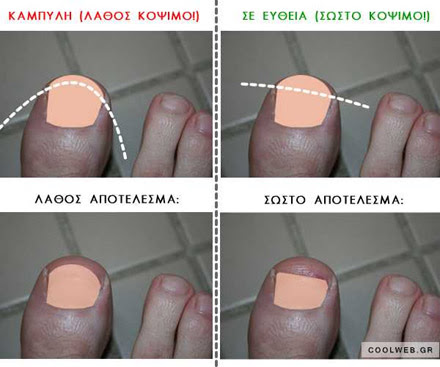 νύχια ποδιού μπαίνουν κρέας