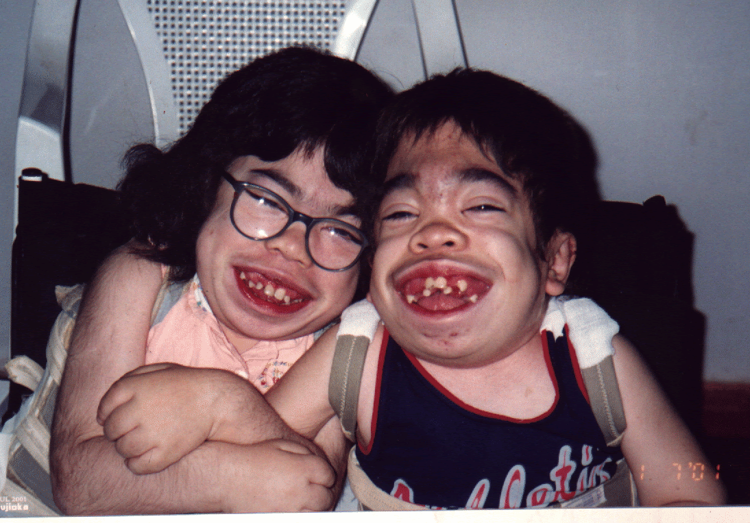 Morquio Syndrome Wtf