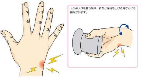 Tfcc損傷 三角線維軟骨複合体損傷 の手術 南川整形外科