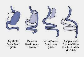 weight loss surgery options