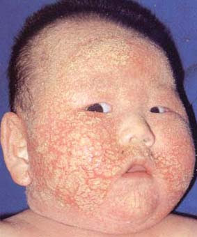 乳児アトピー性皮膚炎重症度別対処の仕方