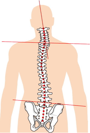 骨盤の歪みをストレッチでなおすのは簡単ではない