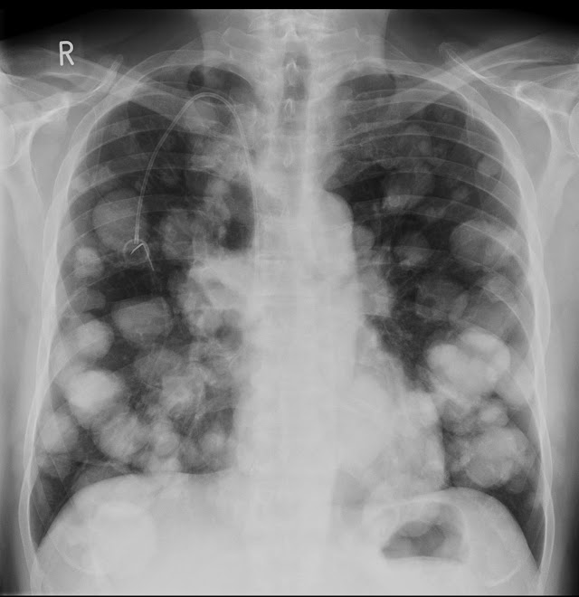 Prostate Cancer Metastasis To Lung - BREAST CANCER RIB METASTASIS | buyxraysonline