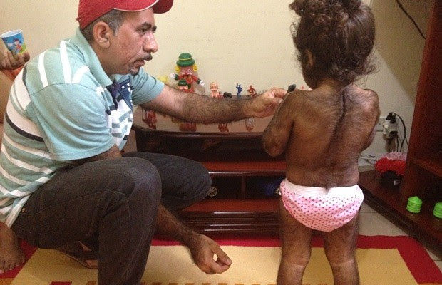 Pai conta que também nasceu peludo e acredita que problema seja genético (Foto: Fernanda Borges/G1)