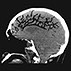 Cerebral Air Embolism Cerebral Air Embolism