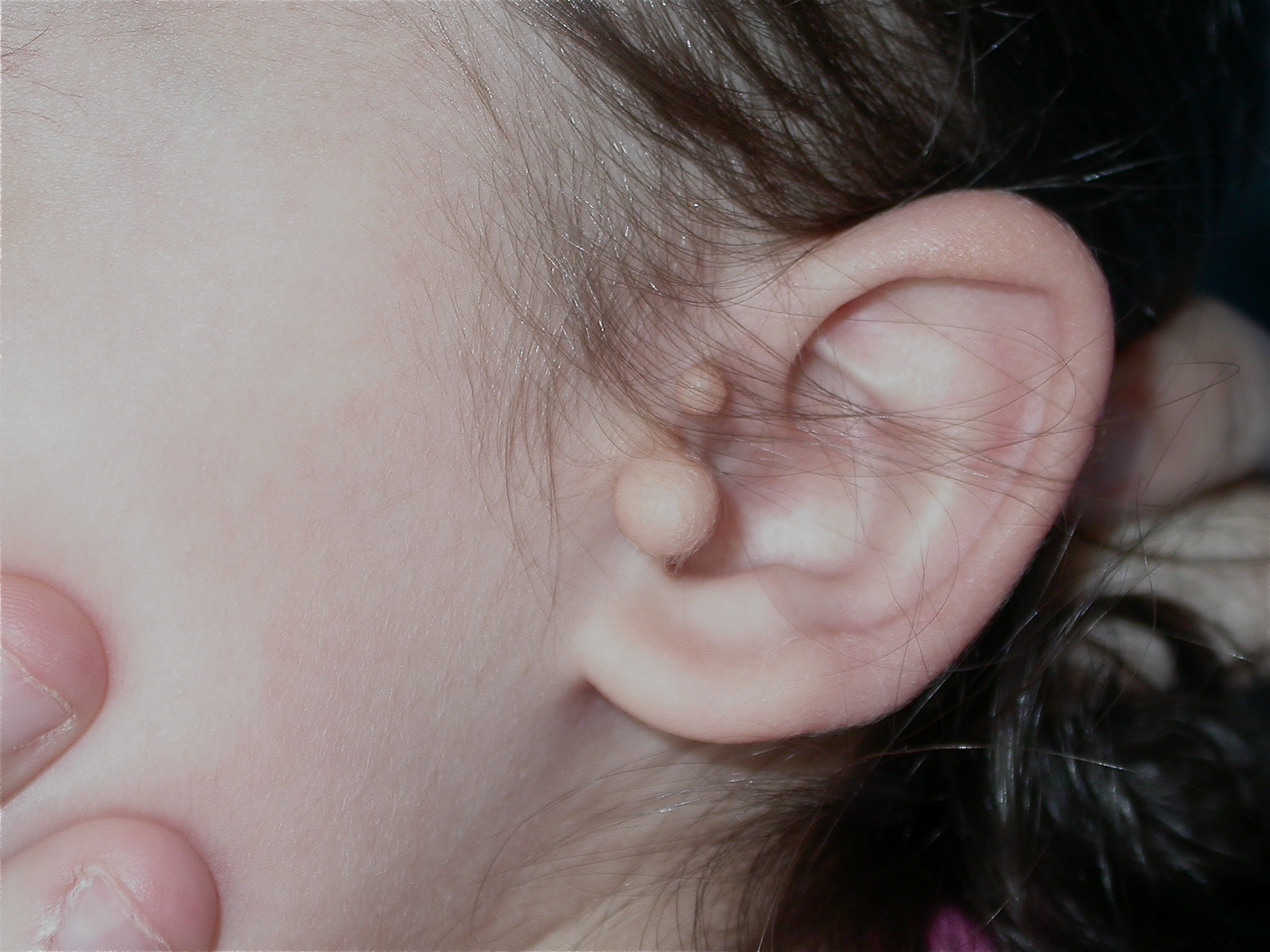Orl Enfant Malformations Des Oreilles