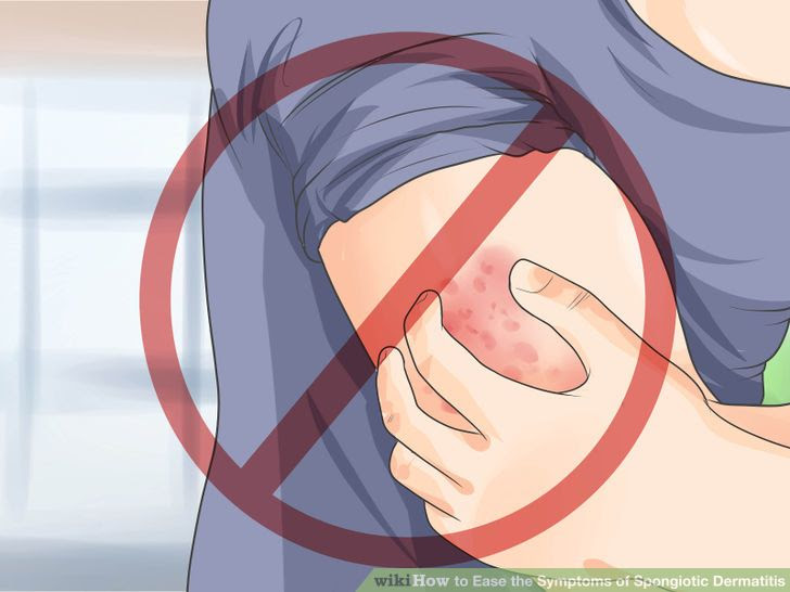 Ease the Symptoms of Spongiotic Dermatitis Step 5 Version 2.jpg